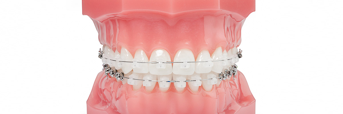 festespange-header Feste Zahnspange